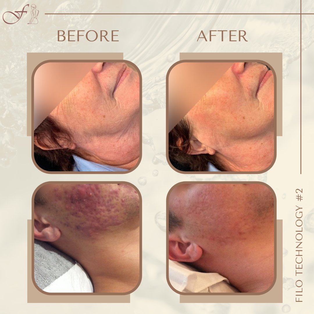 thefiloclinic's tweet image. Now that your outer skin layer is cleaned and refreshed, it is time for a deeper rejuvenation.
#prp #cellularmatrix #aestheticclinic