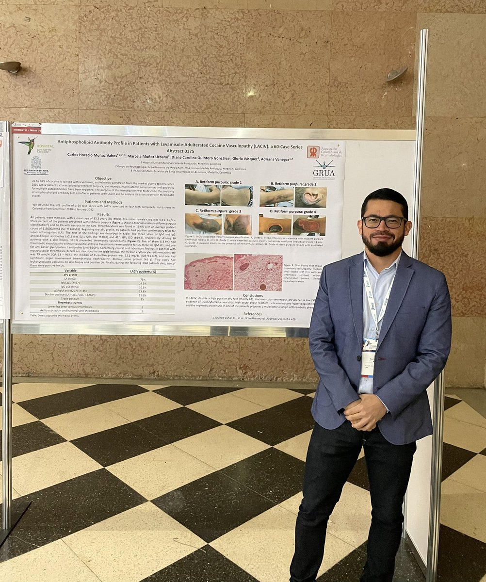 doctorchmunoz's tweet image. Los pacientes con Vasculopatía Inducida por Cocaína-Levamisol tienen anticuerpos antifosfolílipidos positivos en el 75%, trombosis microvascular hasta en el 40%, pero la trombosis macrovascular es infrecuente (5%) #ICAPA2022 @Asoreuma @sanvicentefund @ipsudea @Medicina_UdeA