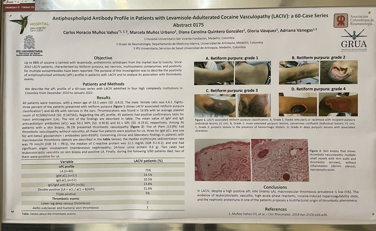 doctorchmunoz's tweet image. Los pacientes con Vasculopatía Inducida por Cocaína-Levamisol tienen anticuerpos antifosfolílipidos positivos en el 75%, trombosis microvascular hasta en el 40%, pero la trombosis macrovascular es infrecuente (5%) #ICAPA2022 @Asoreuma @sanvicentefund @ipsudea @Medicina_UdeA