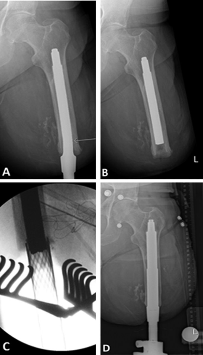 Clinorthop's tweet photo. Septic loosening &amp; stem breakage from metal fatigue is a rare but known cause of ortho implant failure

What are the risk factors for mechanical failure and loosening of a transfemoral osseointegrated implant system in patients w/ a lower-limb amputation?
https://t.co/i00nUVA5ar https://t.co/i9OoLNgn6o