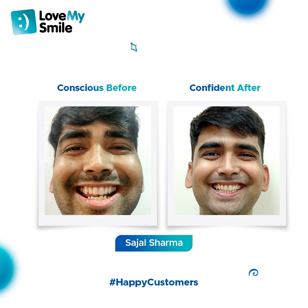 whistleindia_in's tweet image. Sajal Sharma doesn’t shy away from flaunting his #PerfectSmile after getting a smile makeover from LoveMySmile.
Want to be confident of your smile? Book a #SmileScan now! Call us at 88824 29943 for more details.

#LoveMySmile #CustomerTestimonial #HappyCustomers #SmileMakeover
