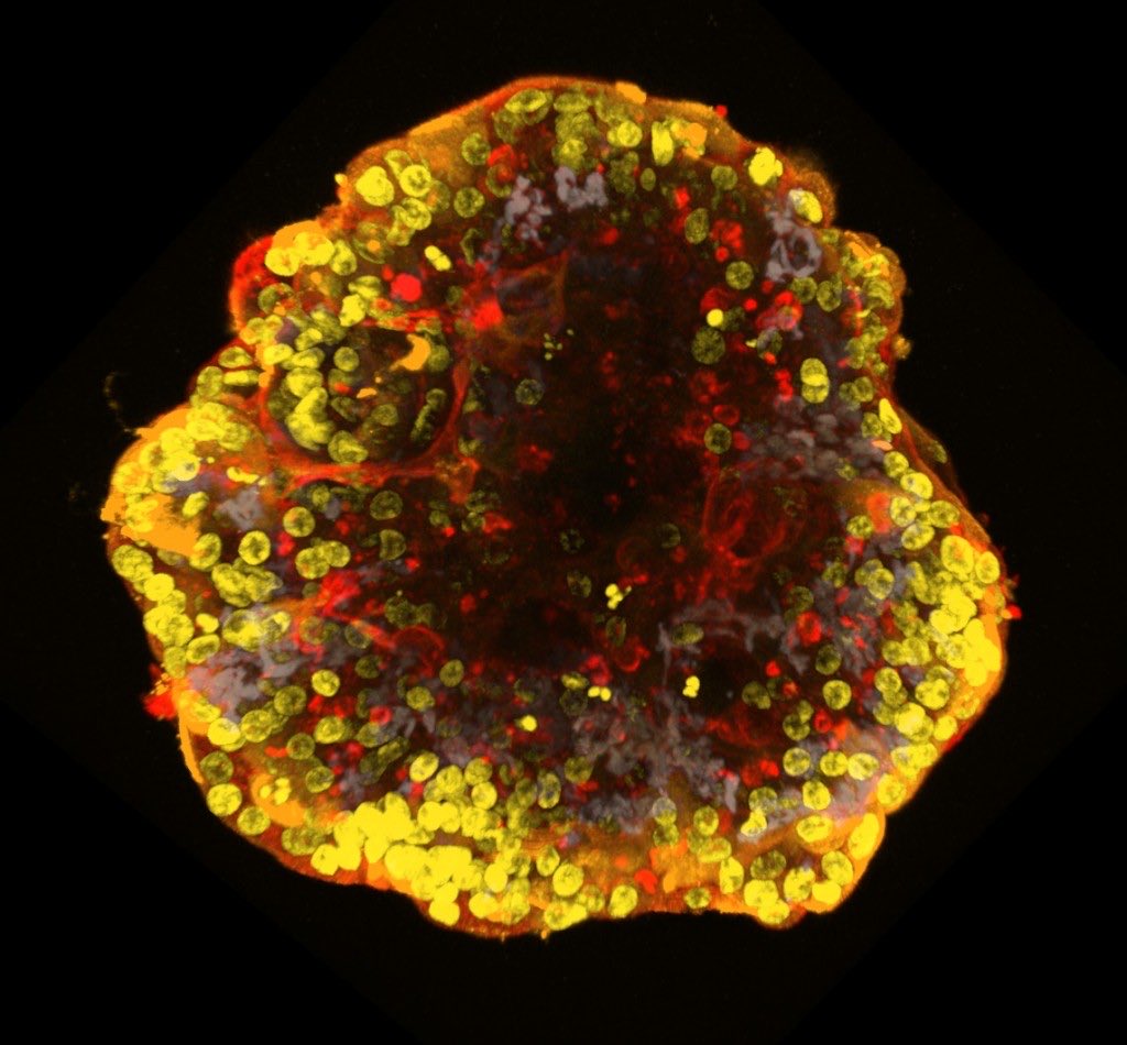 @hay_dave liver spheroids have done it again! Not only are they a great piece of tissue engineering, they look pretty too. 

Thanks you to @OrganOnAChip for selecting my image for first prize. #cancermetastasis #invitromodeling

organonachip.org.uk/imagecomp/resu…