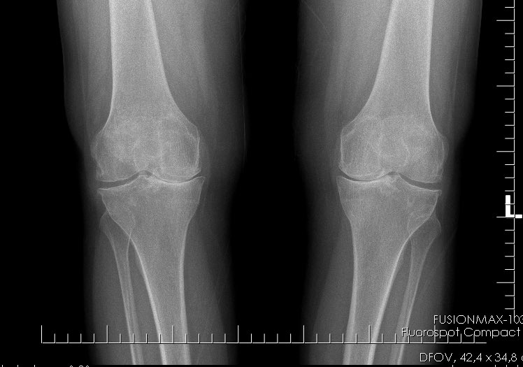 BerivanBitikMD's tweet photo. 60-yo patient with RA, in remission.  Only her knees hurt.  She says “the drugs were very good for me, but they did not work for my knees”.  It was a long process for me to explain to this patient that her knee pain would not improve with rheumatic drugs #rheumtwitter #RheumCases https://t.co/dmRbTnmGHD