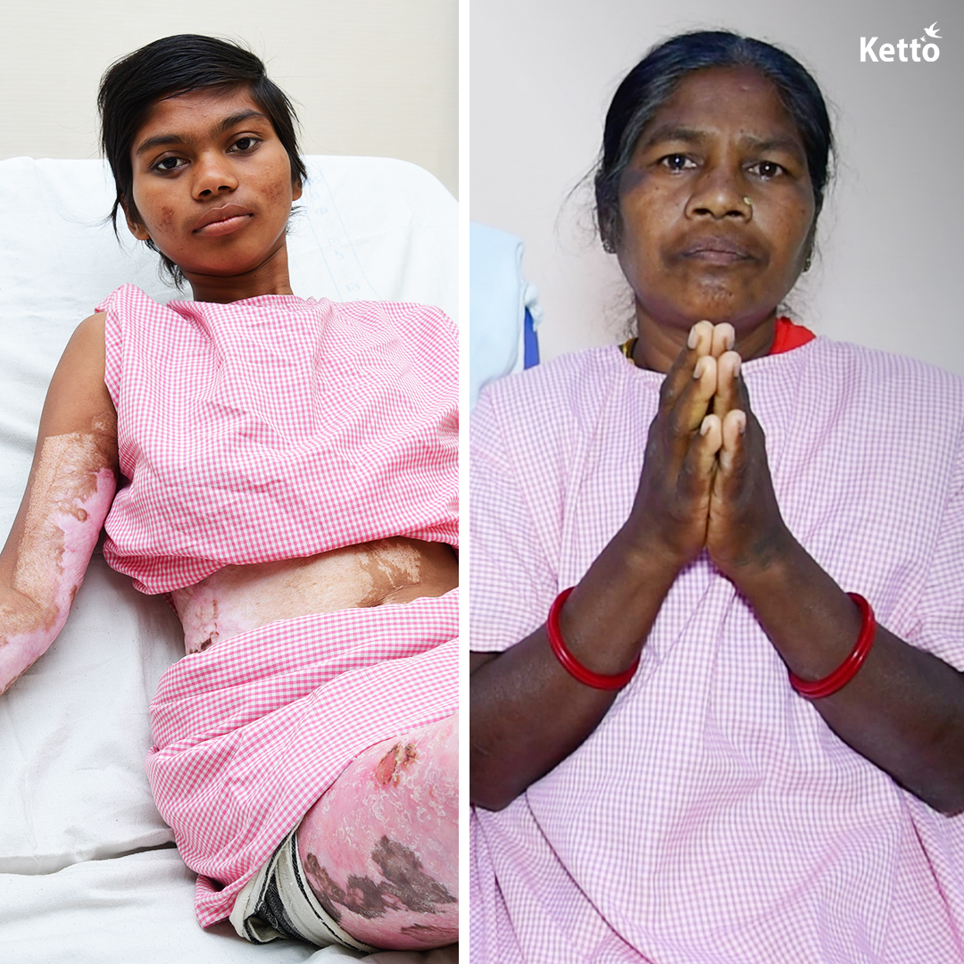 "I have lost my husband, and now my 20-yo daughter has been diagnosed with post-burn contracture after she suffered burns while cooking. She wishes to go out with her friends but cannot stretch her legs, let alone walk, due to her condition."

Please help: bit.ly/Save-Pushpa
