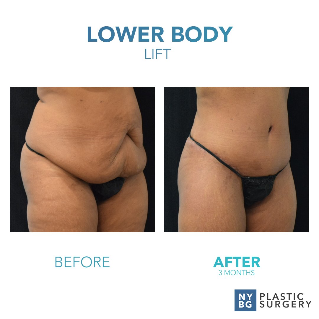 DrKevinSmall's tweet photo. Feel confident in every aspect of your life! Transform the mid and lower body areas with a lower body lift at NYBG Plastic Surgery.

For more before &amp; after photos, visit us at: https://t.co/BxVDHHX06g
#NYBGPlasticSurgery #PlasticSurgeryAfterWeightLoss #LowerBodyLift #Inspiration https://t.co/TseQzEY0lC