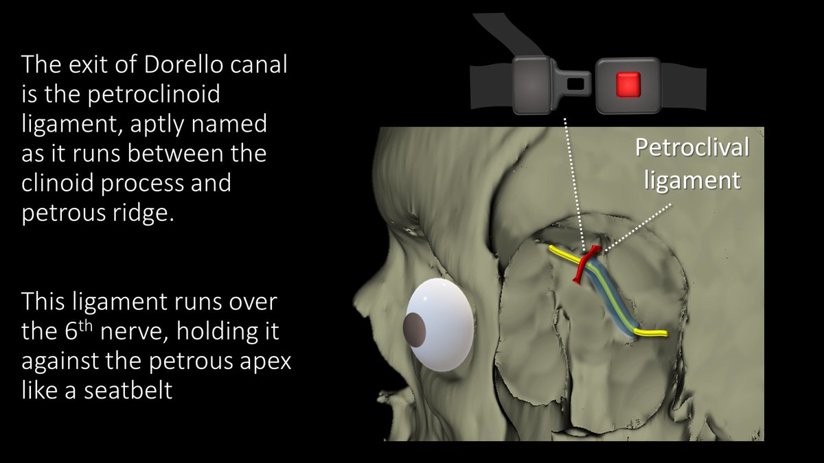 5/ The exit of Dorello canal is marked by the petroclinoid ligament. Which, as its name implies, runs between the petrous ridge and clinoid. The 6th nerve runs under this ligament, which holds it down against the medial petrous ridge like a seatbelt