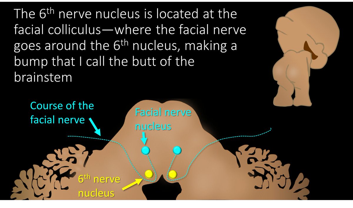 2/To understand the six syndromes, you have to know the anatomy of the 6th nerve. It starts in the brainstem, at the facial colliculus—what looks like the butt of the brainstem. It then travels anteriorly through the brainstem to exit out the ventral surface of the pons.