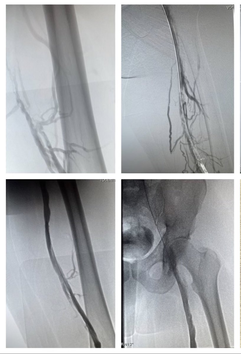 Shamit Desai MD (@shamitsdesai) on Twitter photo 45 yo M with severe PTS. 1 y post provoked DVT. Active job and Villalta 14+. Tough, chronic DVT treated with thrombectomy and venoplasty. 
On d2 for suture removal: "feels like a brand new leg".
1 month f/u to continue clinical management.
<a href="/SaudSAhmedMD/">Saud Ahmed</a> <a href="/SIRRFS/">SIR RFS</a> 45 yo M with severe PTS. 1 y post provoked DVT. Active job and Villalta 14+. Tough, chronic DVT treated with thrombectomy and venoplasty. 
On d2 for suture removal: "feels like a brand new leg".
1 month f/u to continue clinical management.
<a href="/SaudSAhmedMD/">Saud Ahmed</a> <a href="/SIRRFS/">SIR RFS</a>