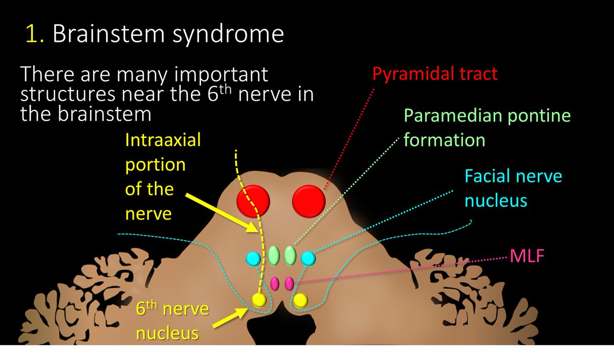 11/In the brainstem, there are many important structures in close proximity to 6th nerve nucleus and its course through the brainstem before it exits. Notably, the pyramidal tracts containing your motor fibers are in direct proximity with the intraaxial 6th nerve.