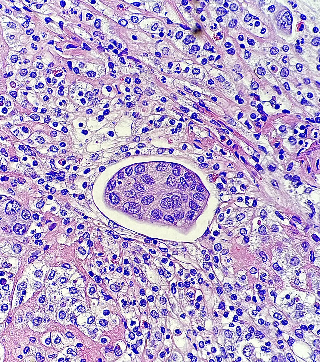 Gloria_SuraMD's tweet photo. Cell block preparation of a pleural effusion showing an adenocarcinoma cell cluster surrounded by a pericellular lacunae. #PathTwitter #PathArt #CytoPath #Cytopathology #Cytology #MedTwitter https://t.co/ssVLHgvvTo