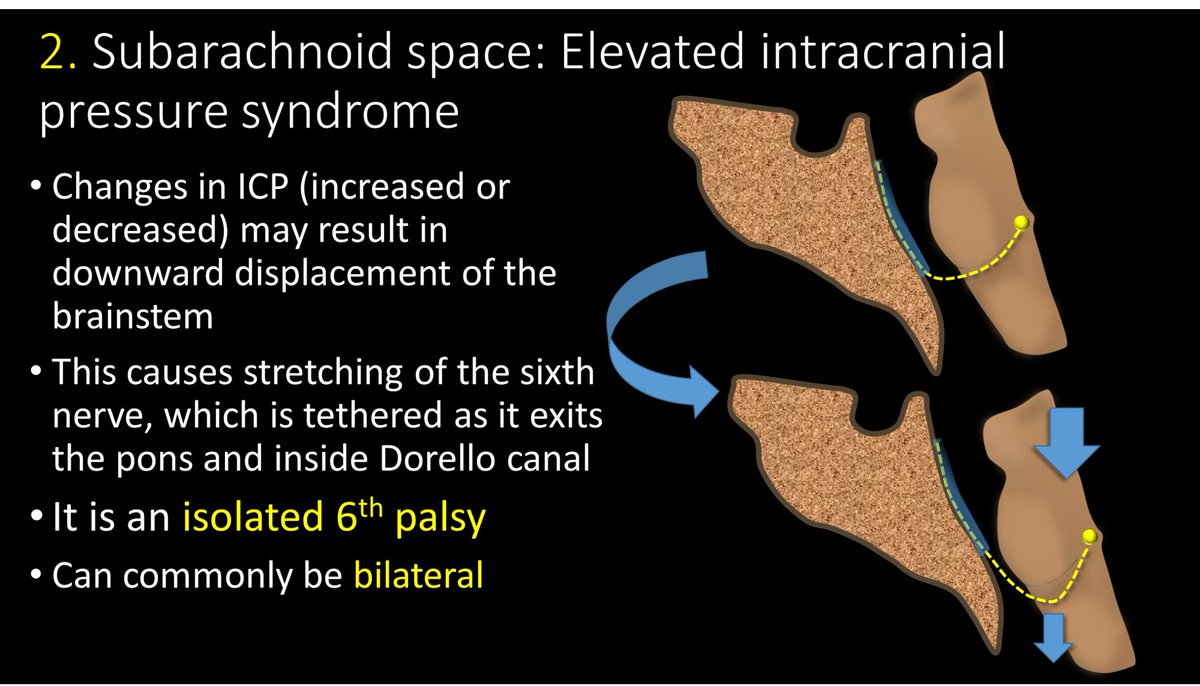 13/As it travels through the subarachnoid space & into Dorello canal, it is susceptible to changes in intracranial pressure. B/c it is tethered in Dorello canal, if the brainstem moves with changes in pressure, it is stretched. This can uniquely give bilateral isolated palsies