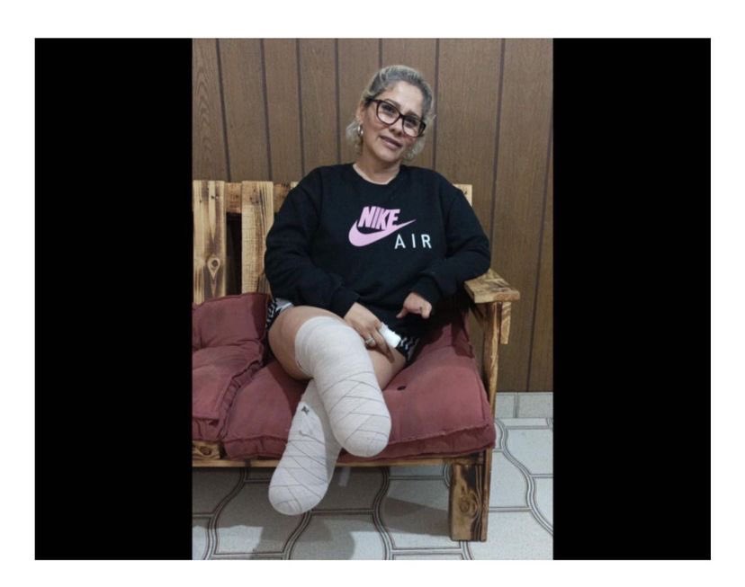 Csofianunes's tweet photo. Katiuska Parada perdió sus piernas producto de una trombosis luego de colocarse la 2da dosis de Astrazeneca. Es venezolana y vive en Argentina. Estamos recaudando $ para q pueda comprar sus prótesis. Pueden apoyar? hasta 10 pesos suman. El alias es: soyleonelcolina https://t.co/CpKeTcfZj6