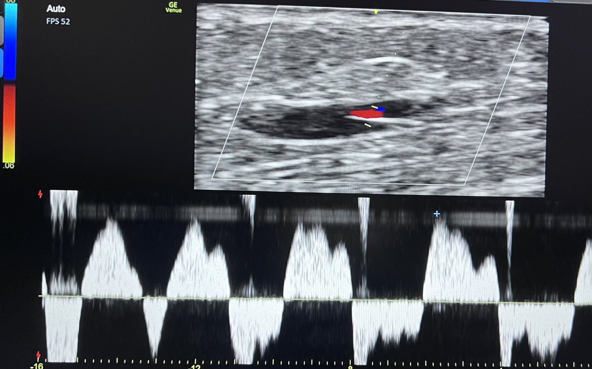 The incompetence of the superficial venous system is appalling.

GSV at the level of the knee. 

Spectral Doppler shown with respiration… what do y’all think?! 

 #VascularSurgery #vascularultrasound #pocus #ultrasound