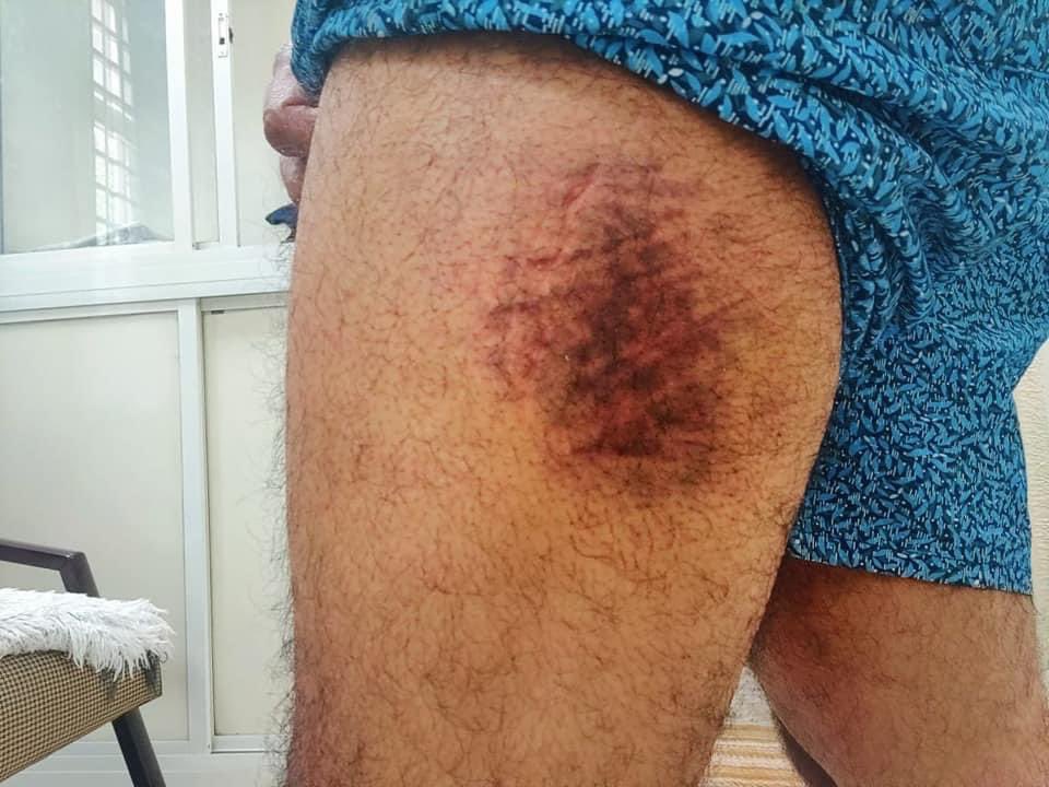 VikrantBhuria's tweet image. वाटर कैनन का ये कैसा दुरुपयोग ? 

रोज़गार की माँग करने वाले युवाओं के साथ अपराधियों जैसा सलूक। वाटर कैनन के तेज प्रेशर से छिड़काव जानलेवा हो सकता था। 

सत्ता का ये कैसा अहंकार !