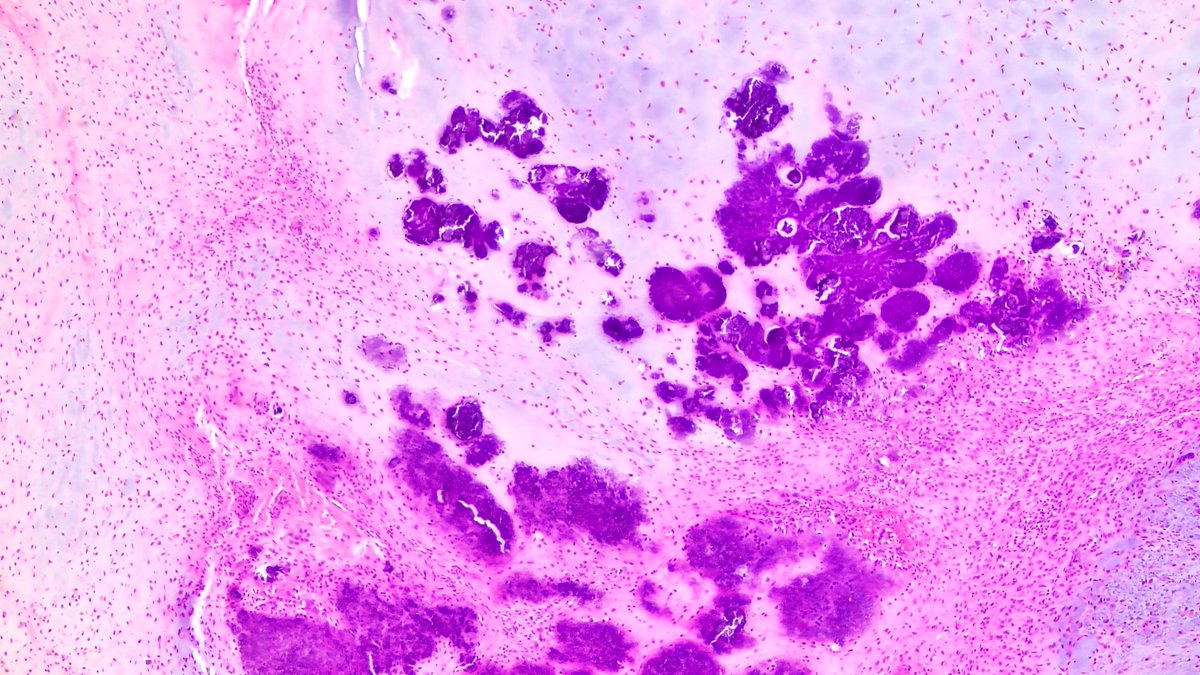 JDCo2pock's tweet photo. 71-year-old woman, 2.5 cm plantar foot mass. Diffuse WT1 expression, patchy IDH1, focal ERG and satB2. AE1/AE3, s100, CD34 negative. FN1 gene rearranged by FISH, supporting phosphaturic mesenchymal tumor with chondromyxoid features, a rare histologic variant. https://t.co/MwK4aaSV2i
