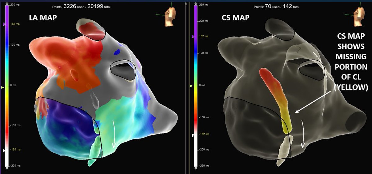 VeronicaCSmith's tweet photo. First burn term in the CS with #TCSE in this perimitral AFL on a redo x2 patient with @HiroshiAshikaga. #EnSiteX and #HDGrid allowed us to see missing AFL CL on the lateral mitral isthmus. CS mapping uncovered the epicardial connection. #MidAmericaEP @AbbottCardio https://t.co/9OEQK0v2uu
