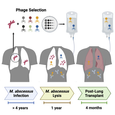 CellCellPress's tweet photo. Now online! Phage treatment of an individual with cystic fibrosis, advanced lung disease, and M. abscessus infection enabled a subsequent successful lung transplant! 🤯🤯
#sciencetwitter #lungtransplant #microbiology 
https://t.co/0fnguy4iZO https://t.co/csFJ9Jcx8O