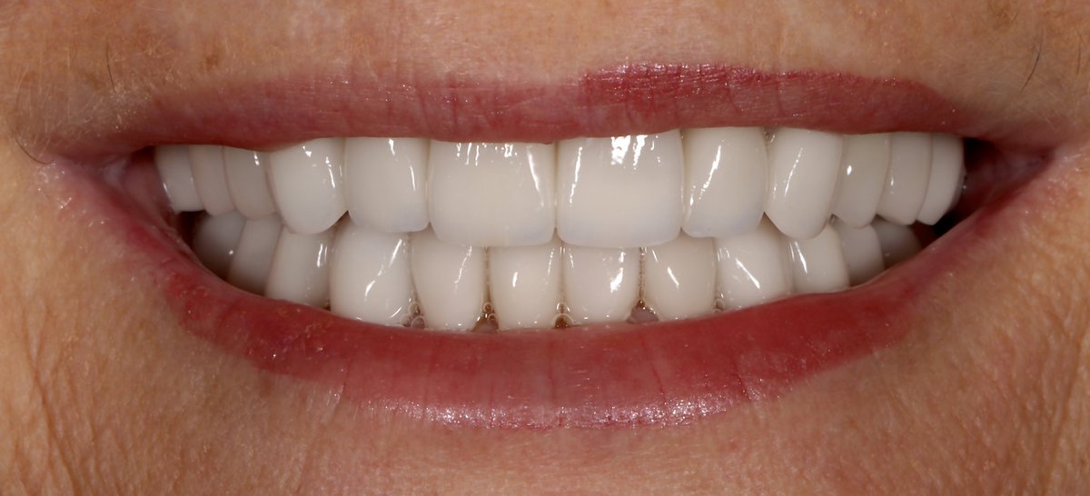 AmarilloSmiles's tweet photo. This client did not like the different colors and shapes of her teeth, and decided it was time to upgrade her smile. She wanted a white smile that she could be proud of. Dr. Miller and our team went to work and gave her the full mouth smile makeover she had been dreaming of! https://t.co/0fqxDggqZa