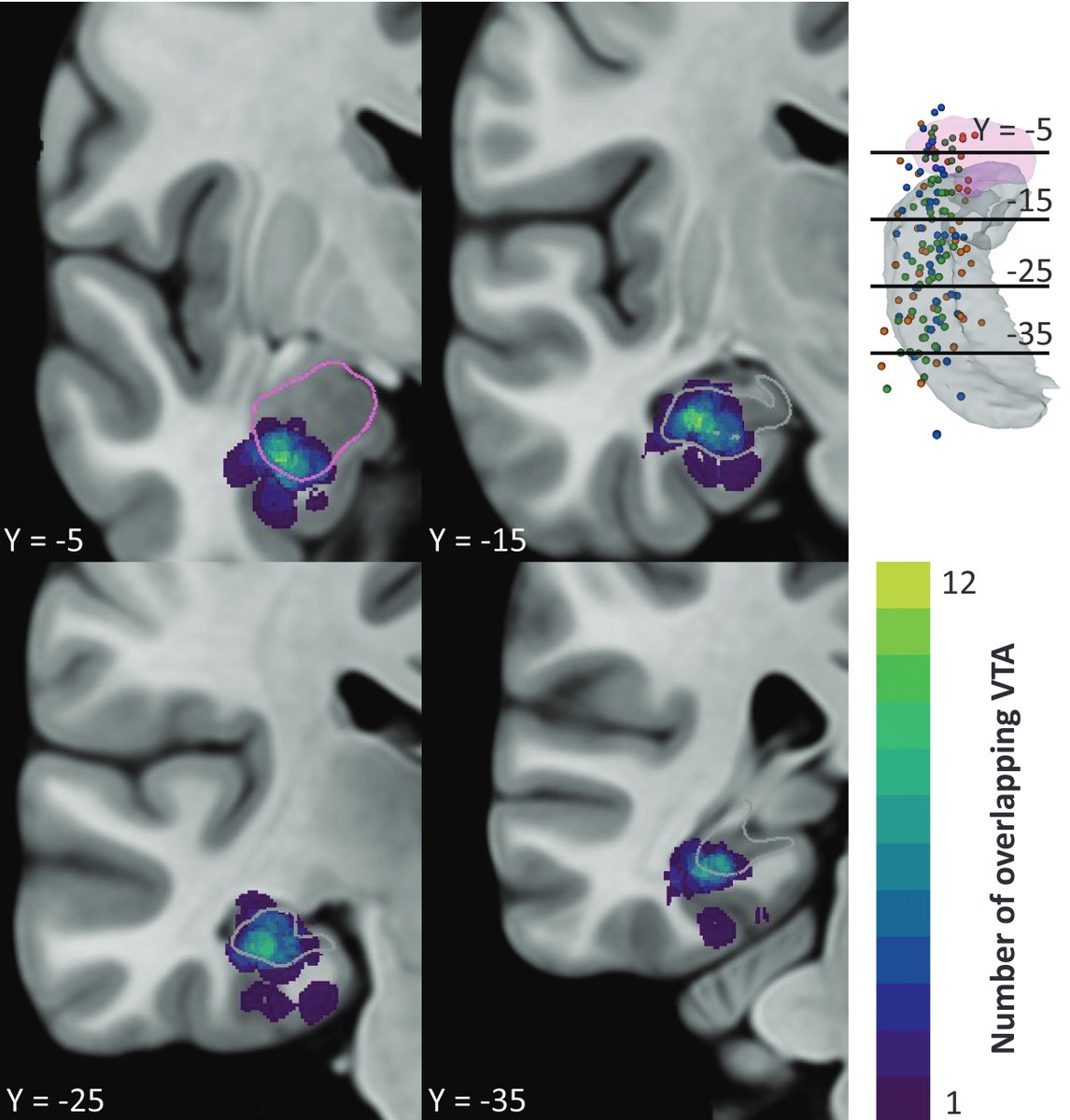 Epilepsia (@epilepsiajourn) on Twitter photo Patient‐specific structural connectivity informs outcomes of responsive neurostimulation for temporal lobe epilepsy onlinelibrary.wiley.com/doi/10.1111/ep…
#epilepsy #epilepsyresearch #temporallobeepilepsy #neurostimulation <a href="/IlaeWeb/">International League Against Epilepsy</a> <a href="/WileyNeuro/">Wiley Neuro</a> <a href="/yesILAE/">yesILAE</a> Patient‐specific structural connectivity informs outcomes of responsive neurostimulation for temporal lobe epilepsy onlinelibrary.wiley.com/doi/10.1111/ep…
#epilepsy #epilepsyresearch #temporallobeepilepsy #neurostimulation <a href="/IlaeWeb/">International League Against Epilepsy</a> <a href="/WileyNeuro/">Wiley Neuro</a> <a href="/yesILAE/">yesILAE</a>