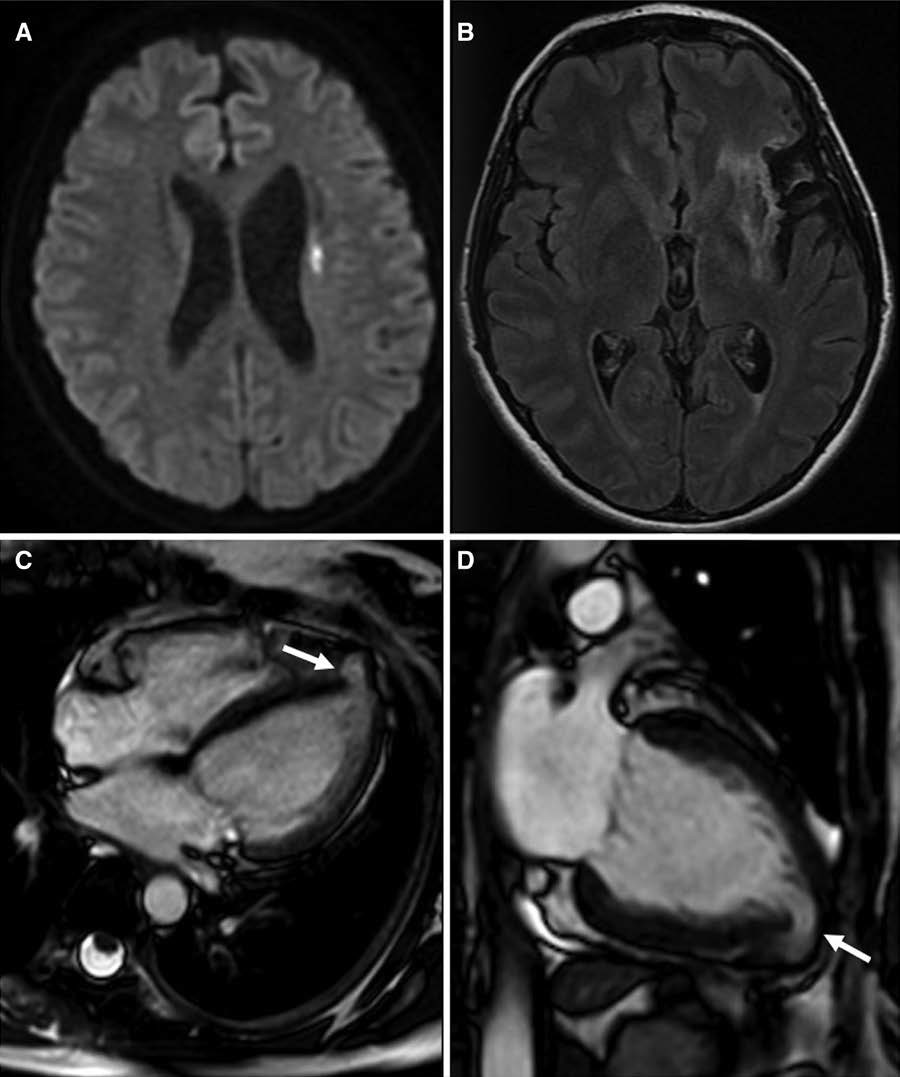 StrokeAHA_ASA's tweet photo. Stroke Images: Congenital Left Ventricular Diverticulum: A Rare Cause of Recurrent Juvenile Cryptogenic #Stroke #AHAJournals https://t.co/8cP5fNQe2I https://t.co/bhlVvpowO2