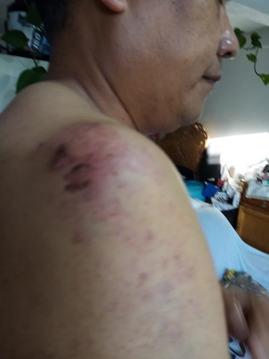 OvsietePlus's tweet photo. Sales a correr y terminas en el hospital con un fuerte golpe en el hombro https://t.co/u2lShRIBwW