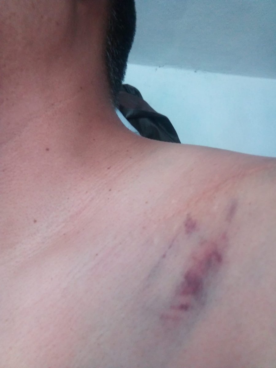 OvsietePlus's tweet photo. Sales a correr y terminas en el hospital con un fuerte golpe en el hombro https://t.co/u2lShRIBwW