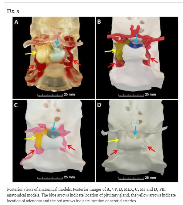 FrankRybicki's tweet photo. Another great article in 3D Printing in Medicine #3DPrintMed Creating accurate 3D anatomical models of pituitary tumors, using different 3D printing techniques.
Article found here: https://t.co/k8uGnlEdLg
#3DPrinting @ClinMedJournals @BioMedCentral @SpringerNature https://t.co/FaIbtlWlSY