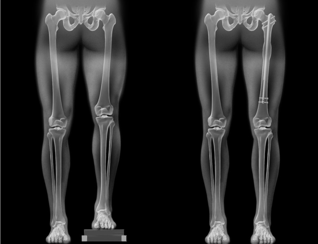 العبد لله كان مشارك في العملية دي قبل كم يوم لمريض حصل ليهو كسر وهو صغير في الكورة وبسببه أحد رجوله أقصر من التانية.
تقنية اتطورت من ٢٠١١م بالمجال المغناطيسي بتزيد طول العظم حتى ٨ سم وتزول معاها كل مضاعفات عدم تواسي الأفخاذ من ألم وصعوبة حركة.
الألمان أسياد هذا الزمان 🇩🇪👏🏾💙