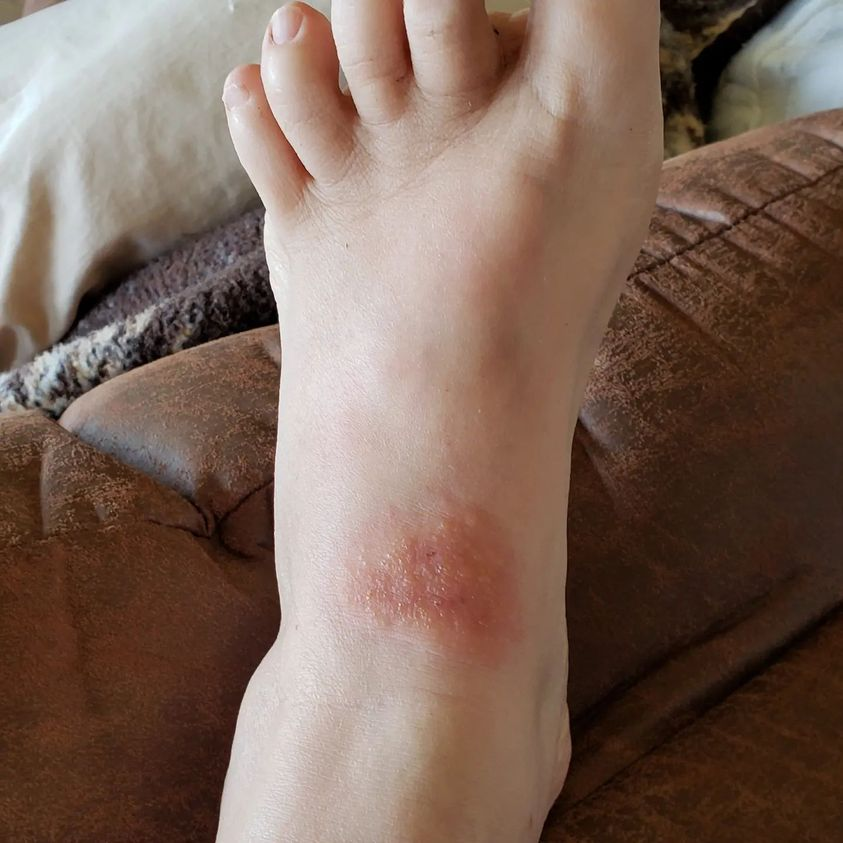 CommonSenseIdea's tweet photo. WATCH OUT! I got phytophotodermatitis from parsnips (you can also get it from Queen Annes lace and other plants)
It's a chemical burn, and takes quite a while to heal.
Learn more at https://t.co/P8f8BvK5J2
#parsnipburn #phytophotodermatitis #dermatitis https://t.co/ic4MCJhJXF