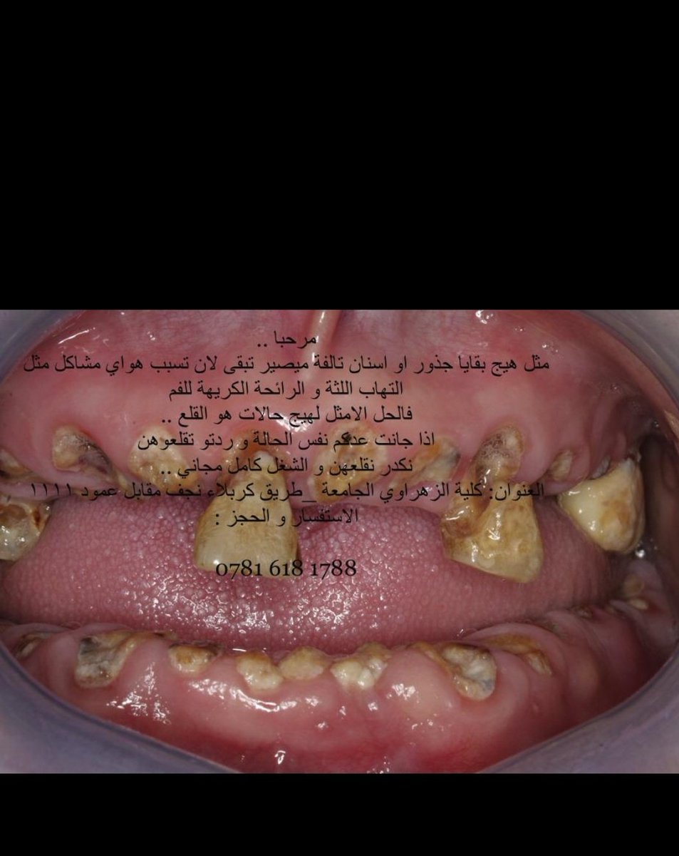 _Nody95's tweet photo. الي عنده هيج سن يحتاج قلع و من كربلاء د. زهراء تتكفل بالموضوع مجاني في كلية الزهراوي الجامعة
للمزيد من التفاصيل مراسلتها @zooz_shb https://t.co/Wrjc0tO8qb