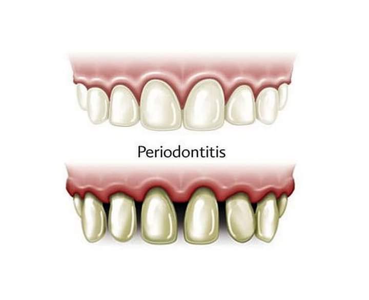 dientes_limpios's tweet photo. PERIODONTITIS 
La periodontitis, es una grave infección de las encías, sin tratamiento esta puede destruir el hueso que sostiene los dientes. La periodontitis puede hacer que los dientes se aflojen o que se pierdan.
 Suele ser el resultado de una mala higiene bucal. https://t.co/TZLsOXAmi2