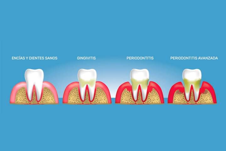dientes_limpios's tweet photo. PERIODONTITIS 
La periodontitis, es una grave infección de las encías, sin tratamiento esta puede destruir el hueso que sostiene los dientes. La periodontitis puede hacer que los dientes se aflojen o que se pierdan.
 Suele ser el resultado de una mala higiene bucal. https://t.co/TZLsOXAmi2