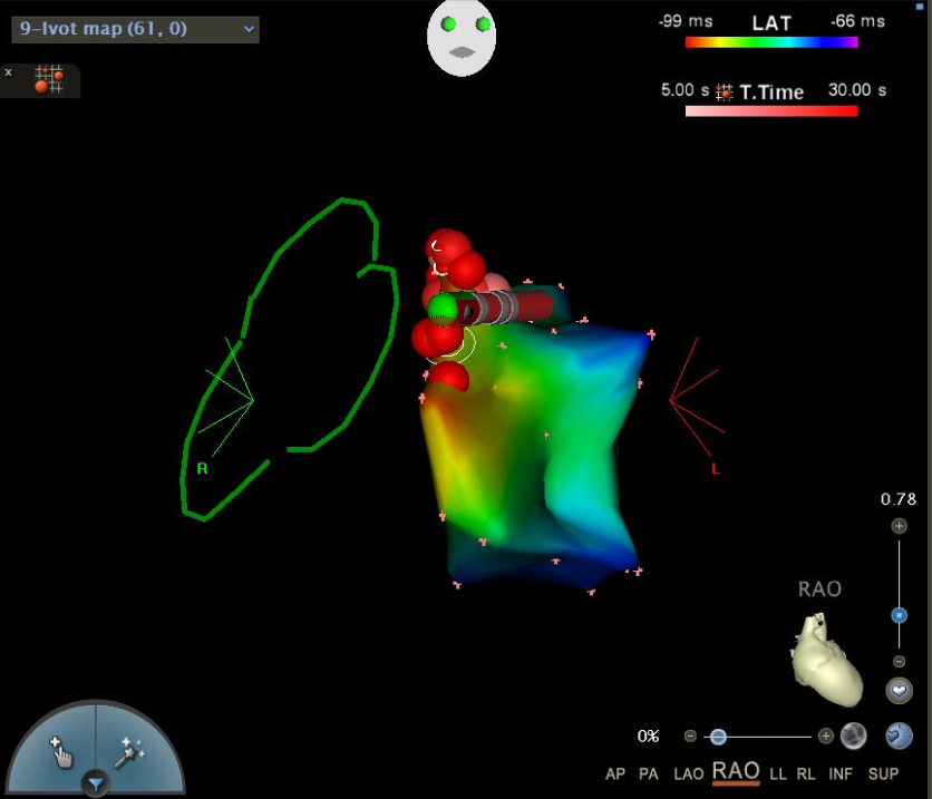 Madhu Reddy (@reddyeps) on Twitter photo Nice case with Stereotaxis!
75 y/o pt with St Jude Mech Aortic Valve with 22% PVC burden from AMC area. Tried manual first and then switched to stereotaxis with very good catheter control around the valve. <a href="/SethHSheldon/">Seth Sheldon MD</a> <a href="/jskoruth/">Jacob Koruth</a> <a href="/Stereotaxis/">Stereotaxis</a> <a href="/Peteweissmd/">Peter Weiss</a> <a href="/DoctorPhillEP/">Phillip Cuculich, MD</a> Nice case with Stereotaxis!
75 y/o pt with St Jude Mech Aortic Valve with 22% PVC burden from AMC area. Tried manual first and then switched to stereotaxis with very good catheter control around the valve. <a href="/SethHSheldon/">Seth Sheldon MD</a> <a href="/jskoruth/">Jacob Koruth</a> <a href="/Stereotaxis/">Stereotaxis</a> <a href="/Peteweissmd/">Peter Weiss</a> <a href="/DoctorPhillEP/">Phillip Cuculich, MD</a>