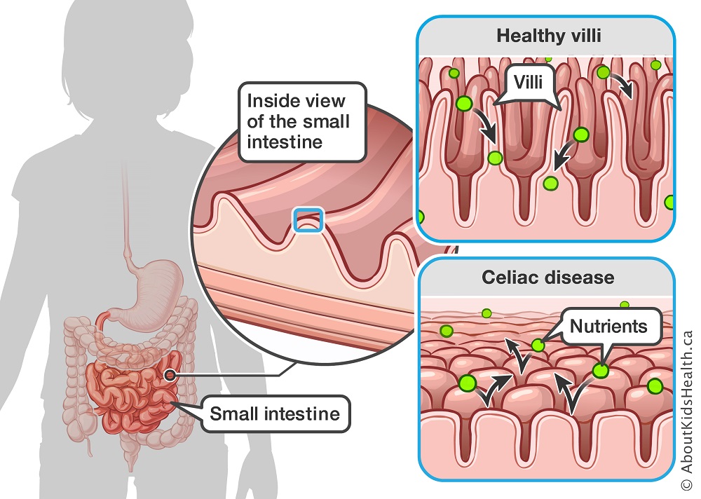 Celiac disease is an autoimmune condition in which any contact with gluten (a family of food proteins) triggers a reaction from the body’s defense (immune) system. Learn how this reaction affects the body: ow.ly/XPmH50ISMXz #CeliacAwarenessMonth