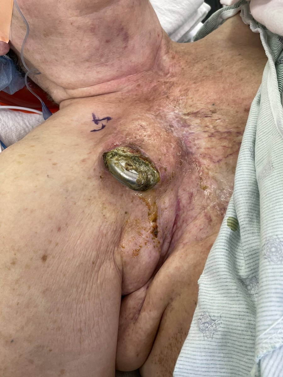 Friday night tough case tweetorial: 84 year old with right sided CRT-D presents with some drainage from her device site that progresses to this: