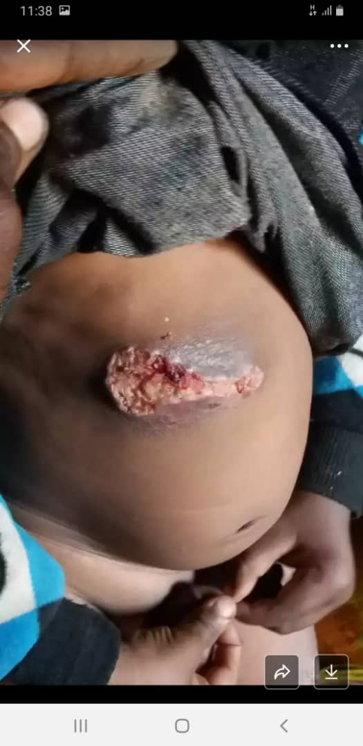 WallooThe's tweet photo. Abiy's regime is carrying out drone &amp; aerial attacks on civilians &amp; public gatherings forcing people to flee to the bushes &amp; mountains. This is one of the victims of drones in Jille-Dhummuga in #Wallo. #EndStateTerrorAgainstOromo https://t.co/fQYKK7Nk7T