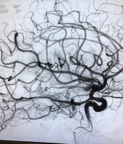 PenNeuro's tweet image. US HCPs: #RED72 delivers results in the hands of Dr. Kurt Reuland at @CHRISTUSTMF. #REDglideDifference #StrokeAwarenessMonth Rx only. For risk info: bit.ly/37YcYIU. Clinical results may vary.