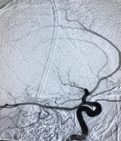 PenNeuro's tweet image. US HCPs: #RED72 delivers results in the hands of Dr. Kurt Reuland at @CHRISTUSTMF. #REDglideDifference #StrokeAwarenessMonth Rx only. For risk info: bit.ly/37YcYIU. Clinical results may vary.