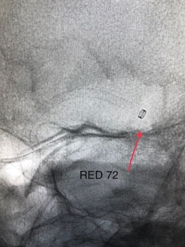 PenNeuro's tweet image. US HCPs: #RED72 delivers results in the hands of Dr. Kurt Reuland at @CHRISTUSTMF. #REDglideDifference #StrokeAwarenessMonth Rx only. For risk info: bit.ly/37YcYIU. Clinical results may vary.