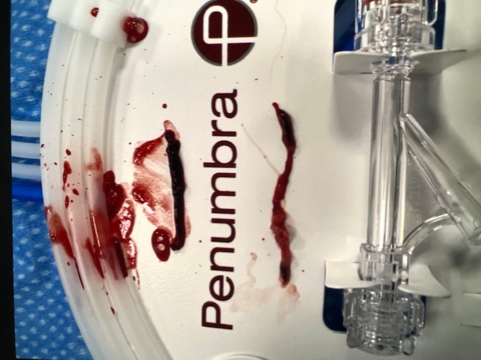 PenNeuro's tweet image. US HCPs: #RED72 delivers results in the hands of Dr. Kurt Reuland at @CHRISTUSTMF. #REDglideDifference #StrokeAwarenessMonth Rx only. For risk info: bit.ly/37YcYIU. Clinical results may vary.