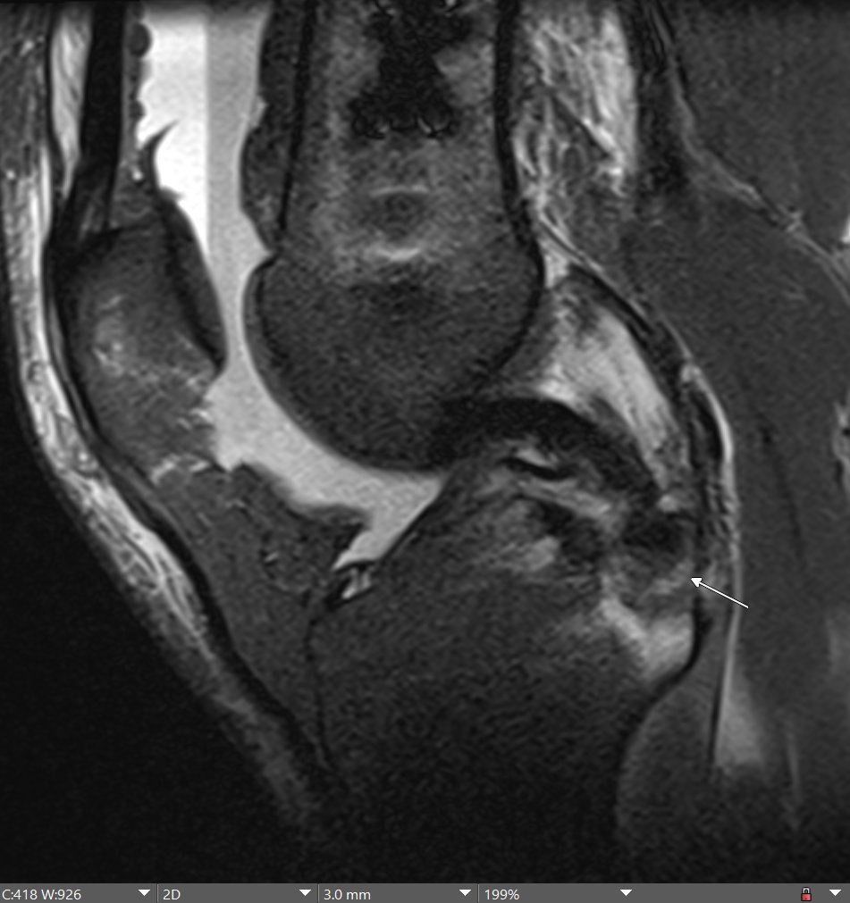 MRI-RADIOGRAPHY CORRELATION: Posterior cruciate ligament tibial avulsion fracture. Difficult x-ray dx if only minimally displaced. On the lateral view, fx projects below the joint line. @nyu_mskrad @ssr_rwg @ESSRmsk @ocad_msk @MskSerme @intskeletal @NYURadRes