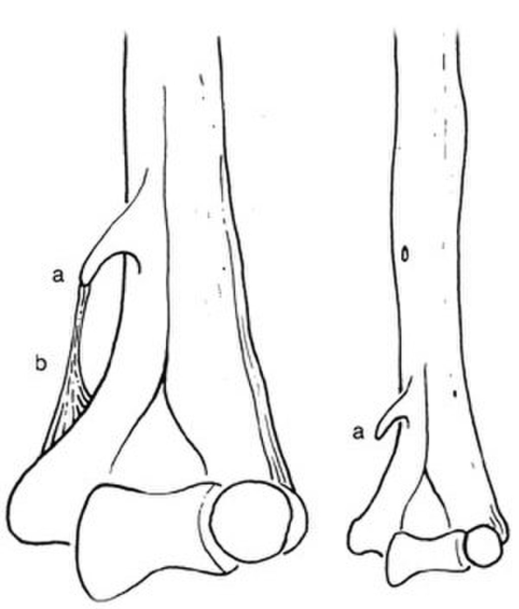 ClinicaCEMTRO's tweet photo. El ligamento de #Struthers, llamado así por el anatomista Sir John Struther, discurre en el codo desde un proceso #supracondíleo de presencia variable hasta el #epicóndilomedial.
¿Sabías que está presente en algunos humanos pero se asemeja a la anatomía de los gatos? 🐈 https://t.co/NC3DbsrvPQ
