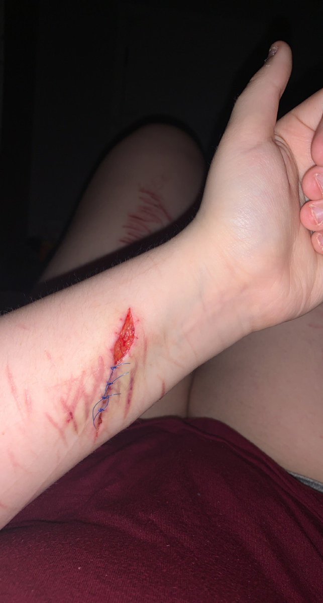 alrighty222's tweet photo. i opened up some of my stitches and now i’m gonna get high so goodbye https://t.co/h5mz5tTuEA