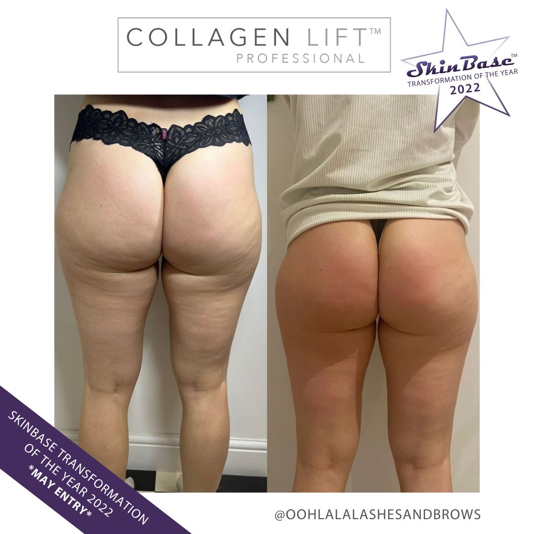 SkinBase_facial's tweet image. ⭐️ May transformation with this fabulous entry from Ooh La La Lashes and Brows

These fantastic results were achieved through a 6 treatment course of Collagen Lift.

Click the link in our bio for your chance to Win a Holiday! #skinbase #collagenlift #transformation22