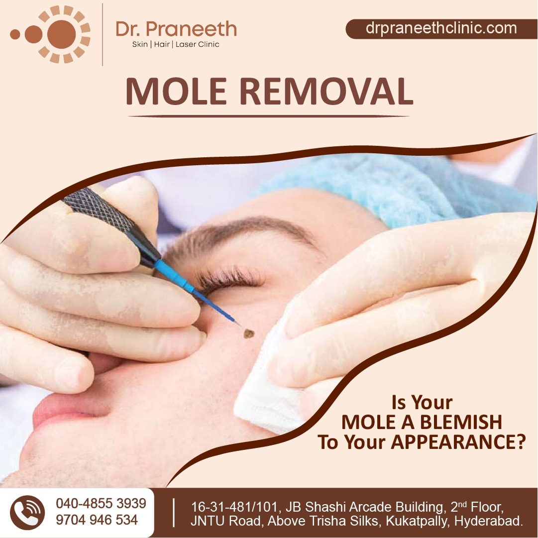 DrPraneethKumar's tweet photo. Is Your Mole A Blemish To Your Appearance?
We Have Solution
Visit - https://t.co/9ejlFHOpdt
Book Your Appointment - 9704946534/040-48553939
 #moleremoval #MoleRemovalTreatment #skinappearance #keloids #dermatologistskincare #dermatologisttested #moleskine #moles #KPHB #Hyderabad https://t.co/9QsHYa34sW