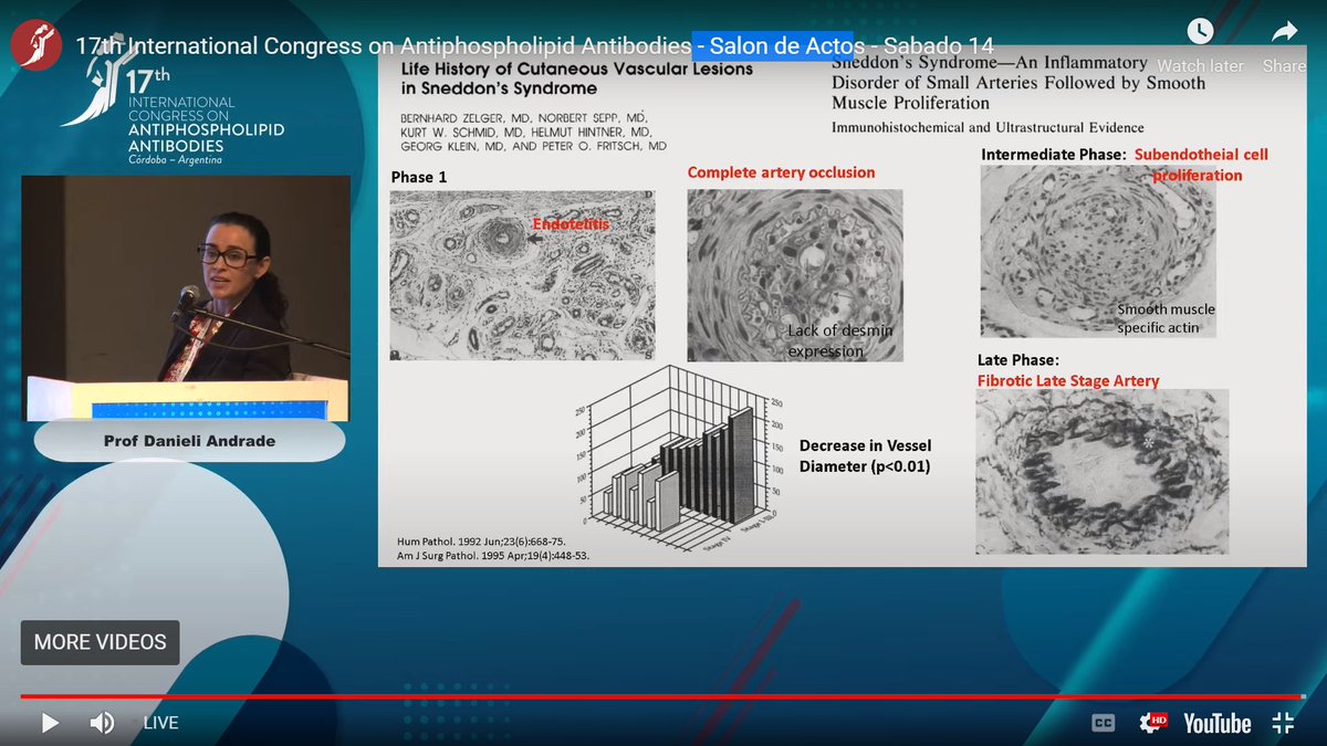 jasonsknight's tweet image. Ooh the great @daniandradeaps with a deep dive of livedo in #APS at #ICAPA2022 🇦🇷