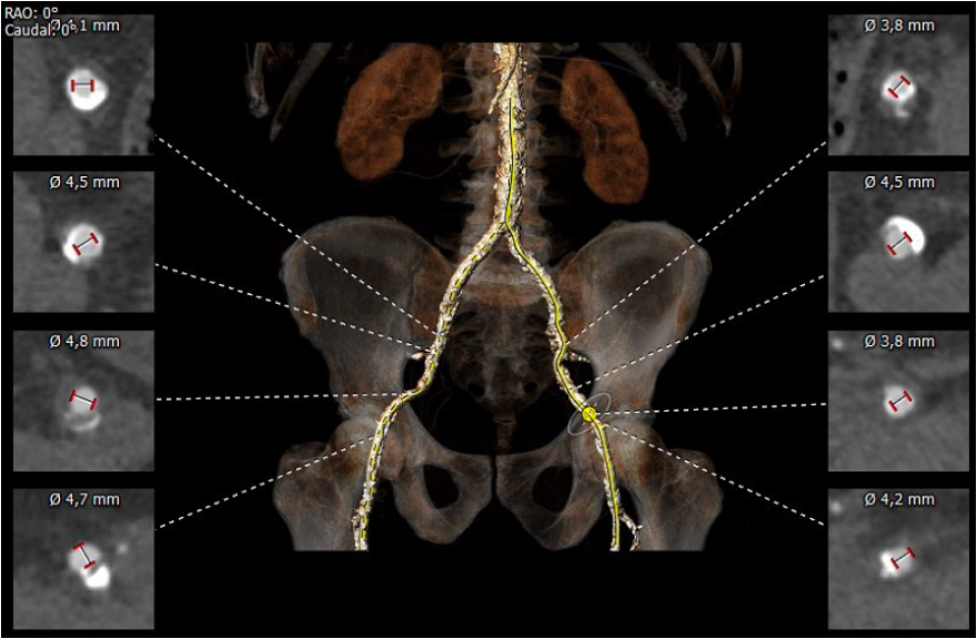 How would you treat these severely calcified #iliac arteries to enable transfemoral #TAVI delivery? On 19 May at #EuroPCR, see how Prof Ole De Backer takes a crack at it with the new #ShockwaveM5plus.
Learn more: blog.shockwavemedical.com/europcr-2022

ISI bit.ly/3iEq7fC #CardioTwitter