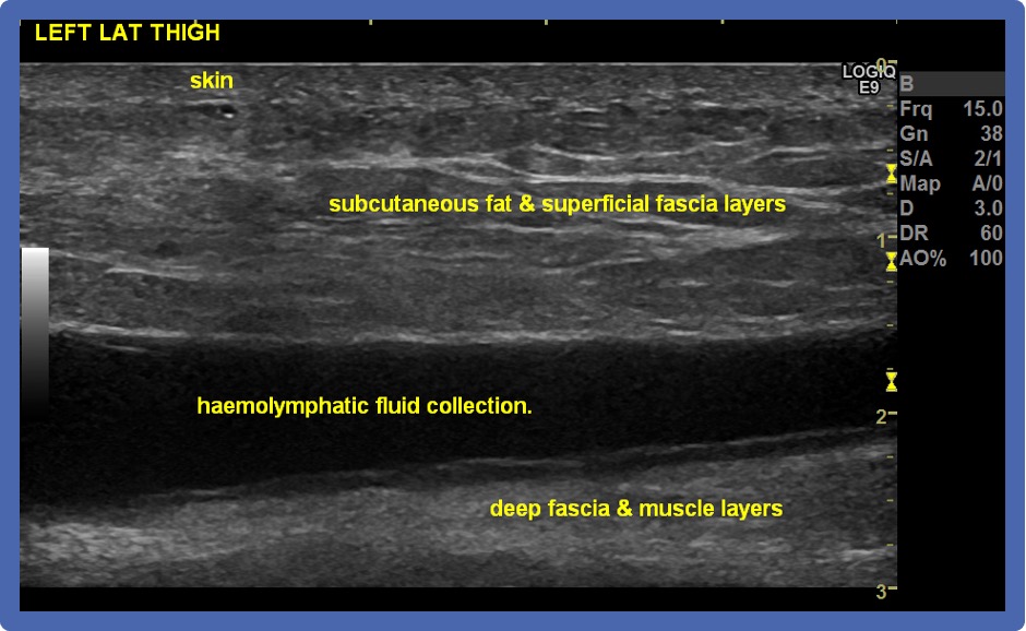 BJSM_BMJ's tweet photo. 🚨 NEW #blog: Morel-Lavallee Lesions 🦴🤔

Do you know the aetiology of this injury❓

What is the optimal diagnosis, investigations and management❓

READ MORE HERE ➡️ https://t.co/tvKEYkV1eA https://t.co/RW0JhvRJPM