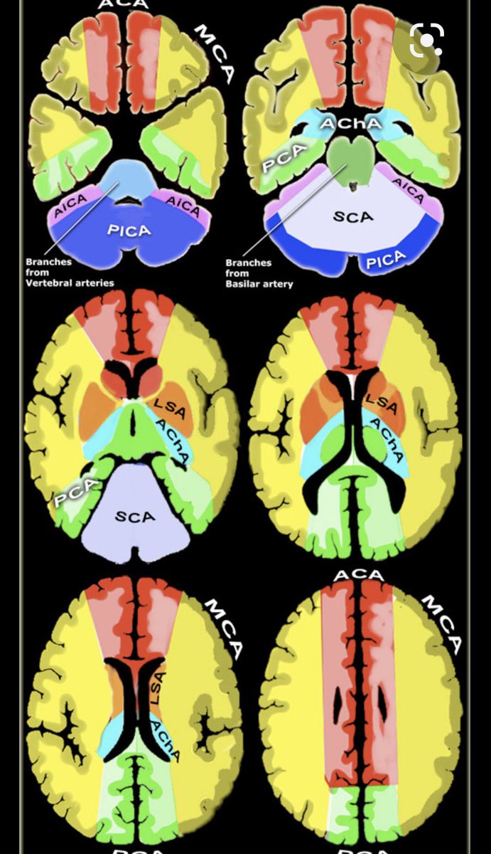 OGdukeneurosurg's tweet photo. #Neurosurgery tip #56: know all cerebrovascular territories and stroke syndromes like you know your best friend. For superstar status, be ready to teach me about Artery of #Percheron infarctions. #MedTwitter https://t.co/jT1gSLcCSN