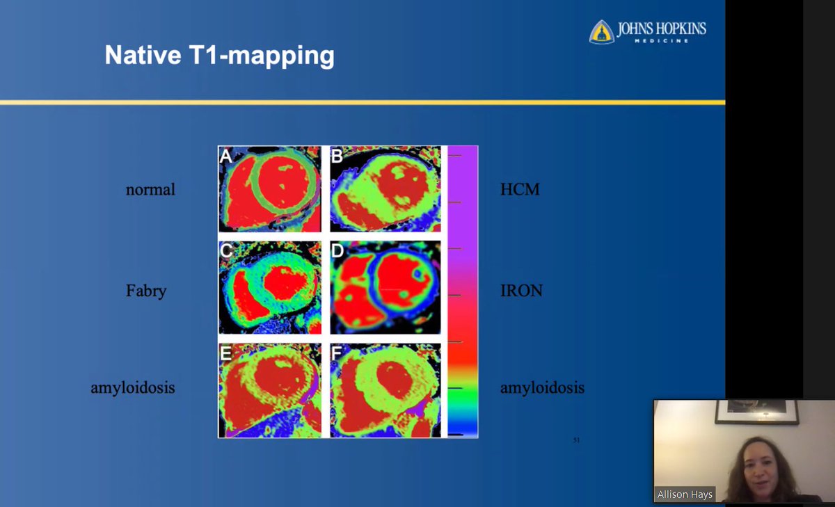 Antony Anandaraj (@antanee) on Twitter photo Happening now! Imaging evaluation of ARVC & Infiltrative cardiomyopathies by Dr. Hays
<a href="/AllisonGHaysMD/">Allison G. Hays, MD</a>
#ACCEarlyCareer #IowaACCLectures
<a href="/ACCinTouch/">American College of Cardiology</a>
<a href="/SCMRorg/">Society for Cardiovascular Magnetic Resonance</a>
<a href="/Heart_SCCT/">Heart_SCCT</a> Happening now! Imaging evaluation of ARVC & Infiltrative cardiomyopathies by Dr. Hays
<a href="/AllisonGHaysMD/">Allison G. Hays, MD</a>
#ACCEarlyCareer #IowaACCLectures
<a href="/ACCinTouch/">American College of Cardiology</a>
<a href="/SCMRorg/">Society for Cardiovascular Magnetic Resonance</a>
<a href="/Heart_SCCT/">Heart_SCCT</a>